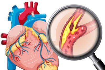 7 bệnh tim mạch thường gặp có thể gây nguy cơ đột quỵ