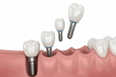 TRỒNG RĂNG IMPLANT – GIẢI PHÁP CHO NGƯỜI MẤT RĂNG LÂU NĂM